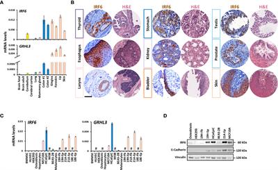 Consistent downregulation of the cleft lip/palate-associated genes IRF6 and GRHL3 in carcinomas